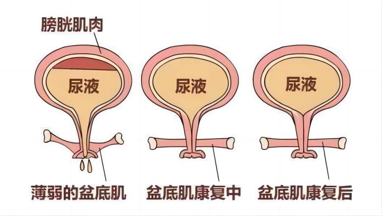 羽豐醫(yī)療丨如何有效運(yùn)用振動(dòng)提高盆底肌肉激活水平？
